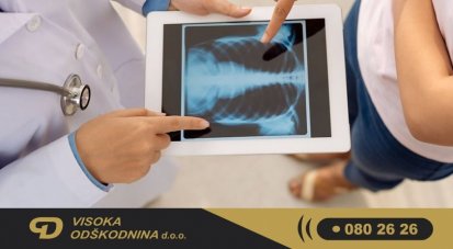 Odškodnina za zlomljeno rebro