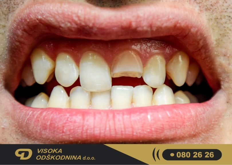 Od&scaron;kodnina za zlom zoba