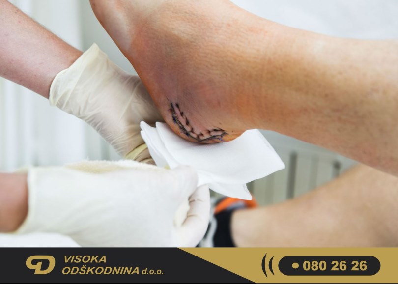 Od&scaron;kodnina za zlom gležnja