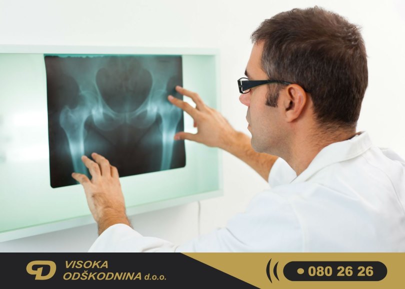 Zlom medenice in od&scaron;kodnina