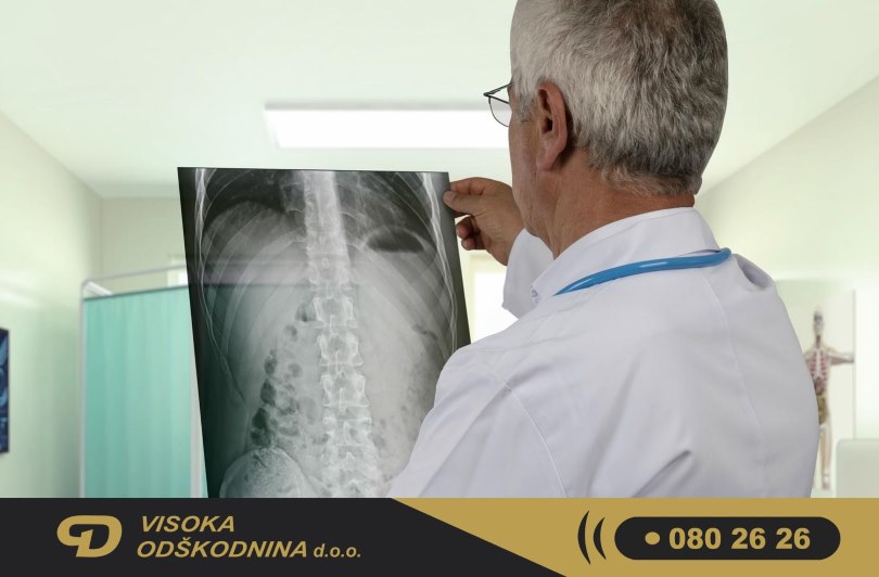 Od&scaron;kodnina za zlom rebra